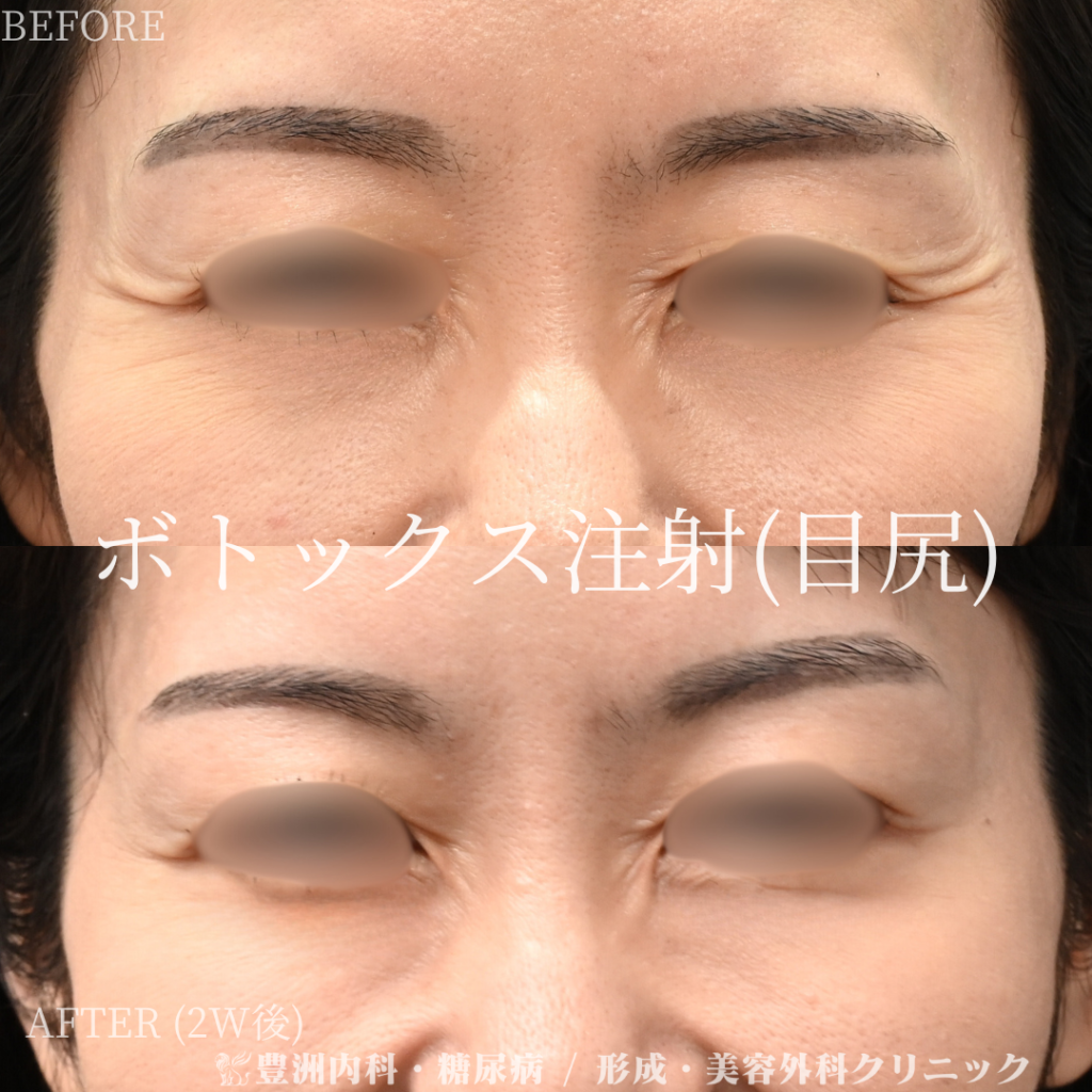 目尻ボトックス / 40代女性